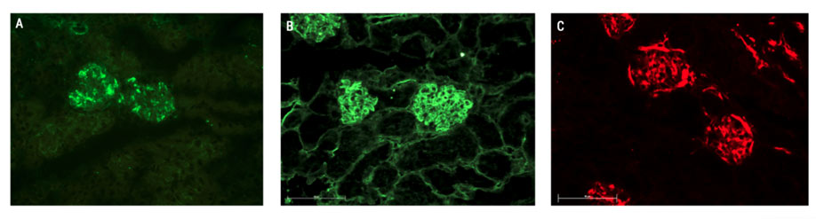 Fluorescence immunohistochemistry for autoantibodies deposition in kidneys` glomeruli: (A) C3 antibody; (B) C3d antibody and (C)
C3b/iC3b/C3c antibody. Scale bar 50μm.